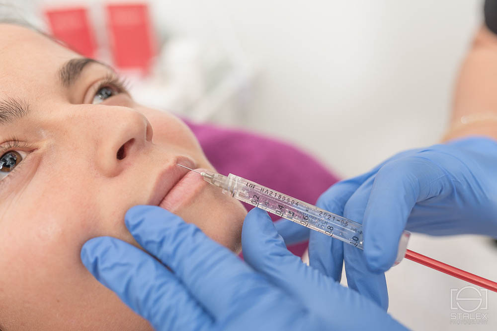 JUVEDERM HIJALURON FILERI - USNE, BORE, ISPRAVLJANJE NOSA