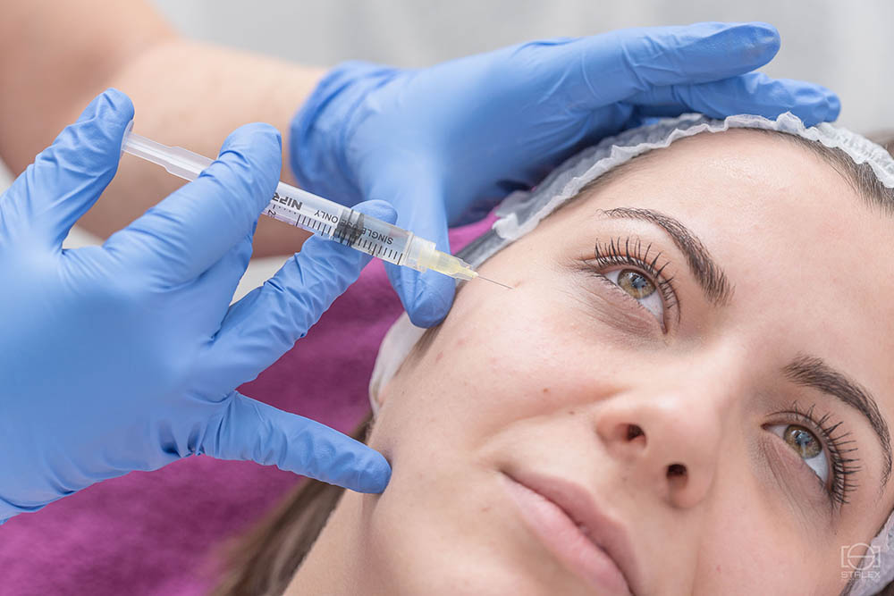 JUVEDERM HIJALURON FILERI - USNE, BORE, ISPRAVLJANJE NOSA